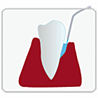 光殺菌（LAD）歯周病治療の手順２