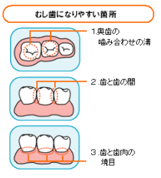 虫歯になりやすい箇所