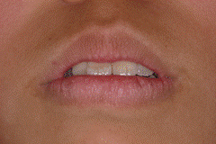 MFT(口腔筋機能療法) 対象症例