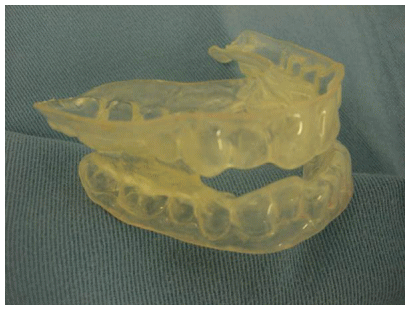 口腔内装置 (OA:Oral Appliance)1