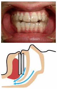 口腔内装置 （OA:Oral Appliance）2