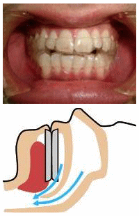 口腔内装置 (OA:Oral Appliance)2