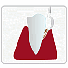 光殺菌（LAD）歯周病治療の手順1