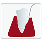 光殺菌（LAD）歯周病治療の手順4